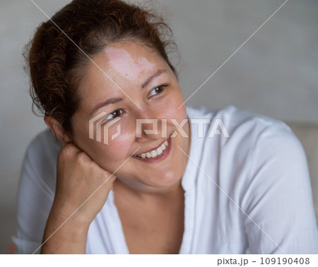 Portrait of a smiling woman with a pigmented spot on her forehead. Girl with Vitiligo Disease. 109190408