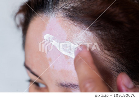 Vitiligo. A close-up portrait of a woman with no skin pigmentation on her forehead. Girl smears sunscreen on a white spot on the skin of the face. Autoimmune disease. Vitiligo. A close-up portrait of a woman with no skin pigmentation on her forehead. Girl smears sunscreen on a white spot on the skin of the face. Autoimmune disease. 109190676