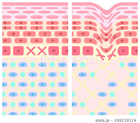 健康な肌としわのある肌の断面図のイラスト素材 [109230124] - PIXTA