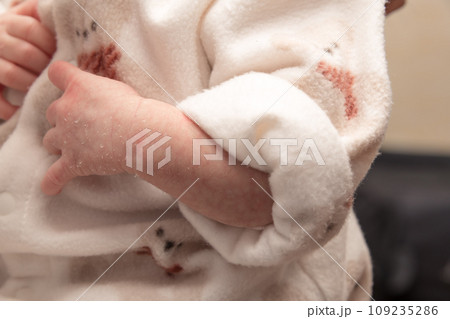 【新生児の赤ちゃん　手の皮が剥ける】 109235286