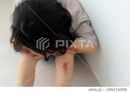子供怪我イメージ（傷は特殊メイクです）　 109254099