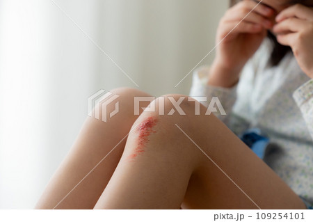 子供怪我イメージ（傷は特殊メイクです）　 109254101