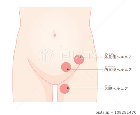 ヘルニア、鼠径ヘルニア、そけい、股関節、骨盤、筋肉、イラスト、illustration 109291470