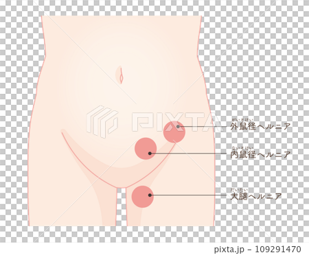 Hernia, inguinal hernia, groin, hip joint, pelvis, muscle, illustration, illustration 109291470