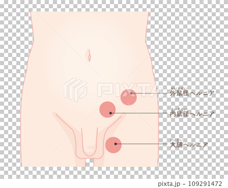 Hernia, inguinal hernia, groin, hip joint, pelvis, muscle, illustration, illustration 109291472