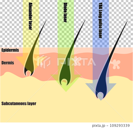在皮膚橫截面視圖中看到的除毛雷射的差異 109293339
