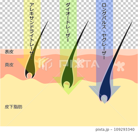 在皮膚橫截面視圖中看到的除毛雷射的差異 在皮膚橫截面視圖中看到的除毛雷射的差異 109293340