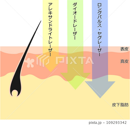 肌断面図で見る脱毛レーザーの違い 肌断面図で見る脱毛レーザーの違い 109293342