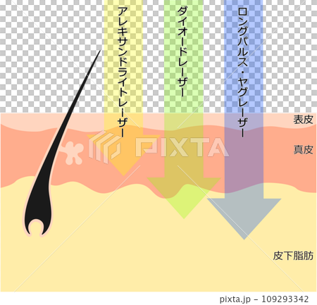 肌断面図で見る脱毛レーザーの違い 肌断面図で見る脱毛レーザーの違い 109293342