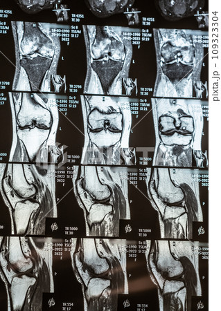 Knee joint x-ray or MRI. Doctor pointed on area of knee joint, where pathology or problem is detected, such fracture, destruction of joint, osteoarthritis. Knee joint x-ray or MRI. Doctor pointed on area of knee joint, where pathology or problem is detected, such fracture, destruction of joint, osteoarthritis. 109323304