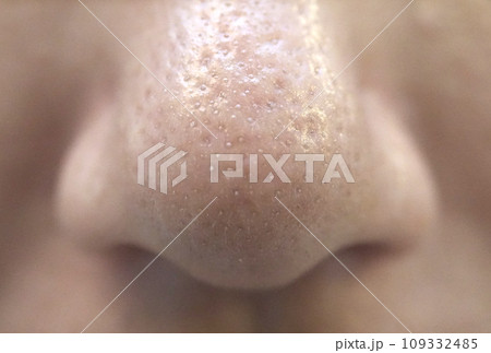 お肌の悩み 角栓の詰まったいちご鼻 お肌の悩み 角栓の詰まったいちご鼻 109332485