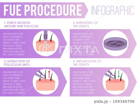 Medical infographic about hair transplantation and fue procedure, vector 109380706