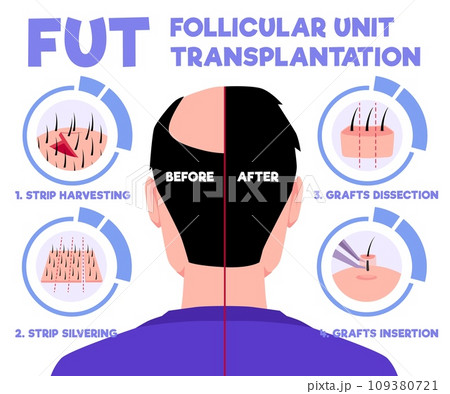 FUT hair transplantation alopecia treatment in 4 steps of follicular unit transplantation restoration surgery vector info FUT hair transplantation alopecia treatment in 4 steps of follicular unit transplantation restoration surgery vector info 109380721