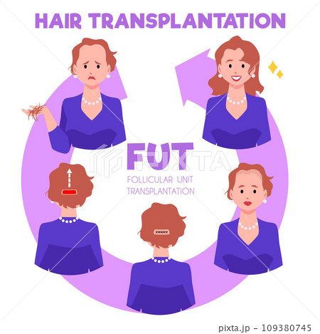 Hair transplantation, medical infographic with woman, vector illustration 109380745