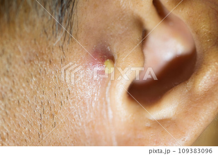 Pus coming from nodular cystic acne in front of the man ear 109383096
