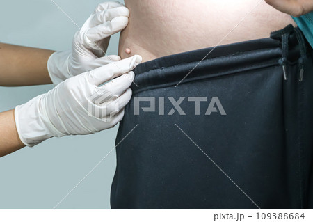 Skin tag or acrochondon or soft fibroma Skin tag or acrochondon or soft fibroma 109388684