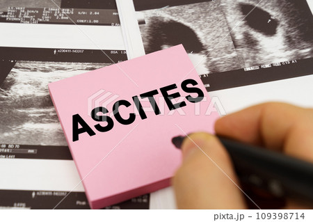 On the ultrasound pictures there are stickers that say - Ascites On the ultrasound pictures there are stickers that say - Ascites 109398714