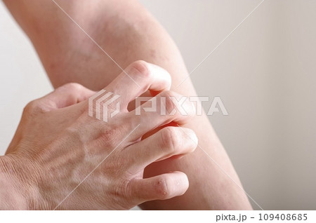 腕をかきむしる男性 腕をかきむしる男性 109408685