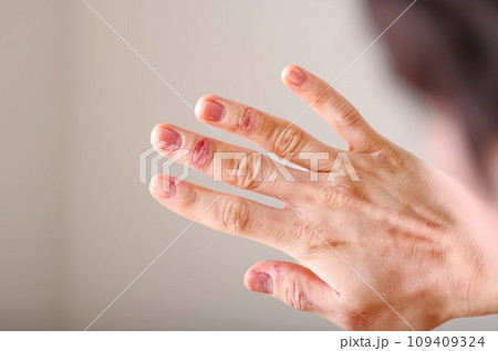 指先のアトピーを見つめる男性 109409324