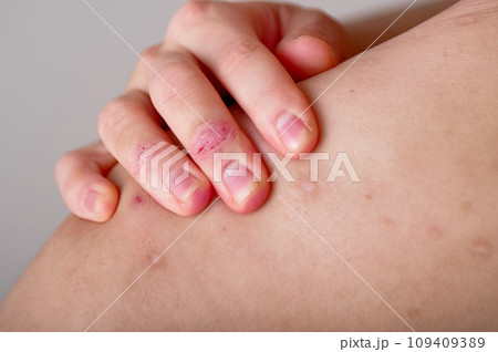 背中のアトピーを気にする男性 背中のアトピーを気にする男性 109409389