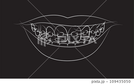 Smile with teeth braces black color Smile with teeth braces black color 109435050