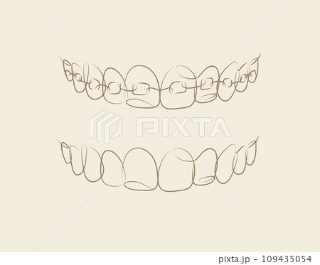 Jaws with and without braces installed beige colorのイラスト素材 [109435054 ...