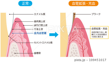 正常な歯茎と充血した歯茎の断面図　比較　歯科　医療 109451017