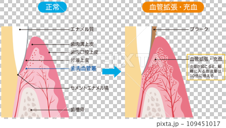 正常な歯茎と充血した歯茎の断面図　比較　歯科　医療 109451017
