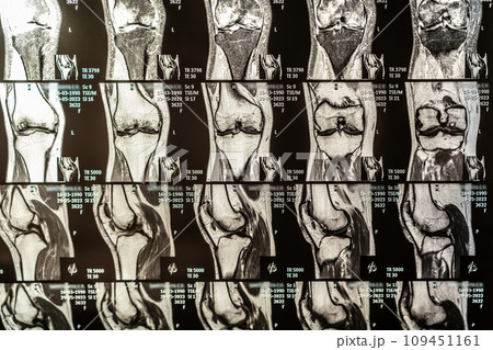 Knee joint x-ray or MRI. Doctor pointed on area of knee joint, where pathology or problem is detected, such fracture, destruction of joint, osteoarthritis. 109451161