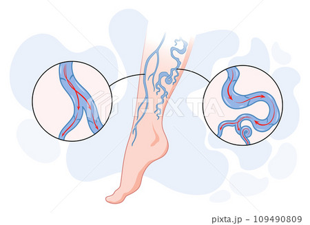 Varicose veins. Blue blood vessel visible through the skin, abnormally swollen leg. Vascular disease diagnostic and treatment. Venous insufficiency medical disease Varicose veins. Blue blood vessel visible through the skin, abnormally swollen leg. Vascular disease diagnostic and treatment. Venous insufficiency medical disease 109490809