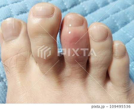 発症ばかりの【右足中指の痛風】 109495536