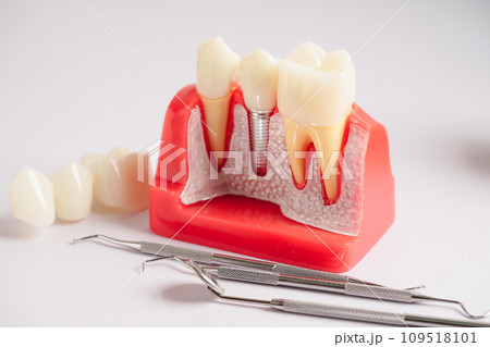 Dental implant, artificial tooth roots into jaw, root canal of dental treatment, gum disease, teeth model for dentist studying about dentistry. Dental implant, artificial tooth roots into jaw, root canal of dental treatment, gum disease, teeth model for dentist studying about dentistry. 109518101