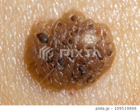 A detailed macro view of a mole with potential indications of malignant melanoma. Concept 109519808