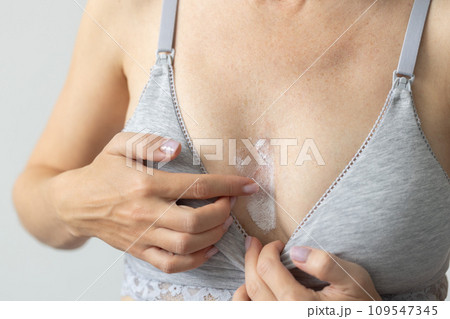 Woman applying healing cream on her skin. Allergy on a chest. Closeup. 109547345