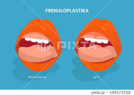 3D Isometric Flat Vector Illustration of Frenuloplastika 109572508