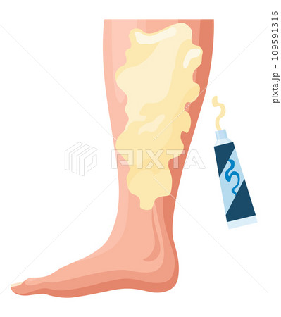Stages or types of varicose veins development. Medical poster or disease infographic. Image of diseased legs. Vector illustration in flat style 109591316