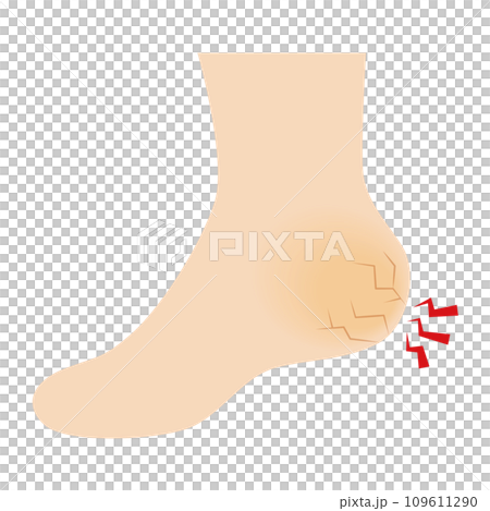 ひび割れたかかとのイラスト 109611290