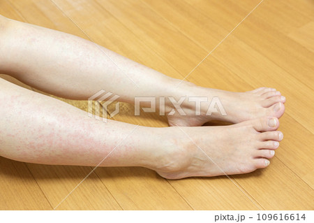 蕁麻疹でかゆい足 109616614