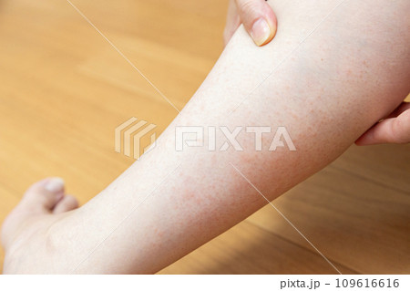 ふくらはぎに蕁麻疹 ふくらはぎに蕁麻疹 109616616