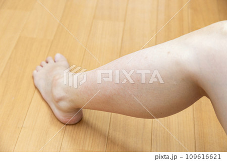 湿疹ができた女性の脚 湿疹ができた女性の脚 109616621