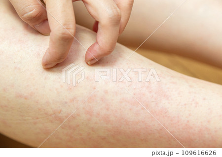 湿疹でかゆい足 湿疹でかゆい足 109616626
