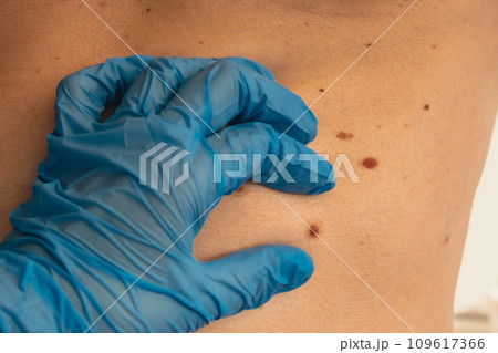 Doctor in medical gloves examining man skin mole. Dermatologist checking male birthmarks. Self care preventing cancer procedure. Protection treatment skin positivity Doctor in medical gloves examining man skin mole. Dermatologist checking male birthmarks. Self care preventing cancer procedure. Protection treatment skin positivity 109617366