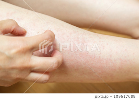 湿疹でかゆい足 湿疹でかゆい足 109617689