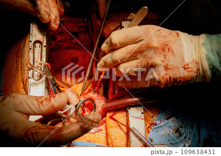 Patient during surgical procedure at open heart in operation room Patient during surgical procedure at open heart in operation room 109638431