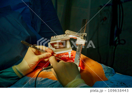 Patient is undergoing surgical procedures during heart valve surgery for removal of expandable transcatheter aortic valves 109638443