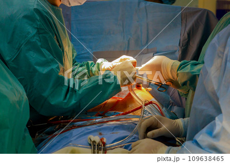 During heart valve surgery, patient undergoes procedure to remove expandable transcatheter aorta 109638465