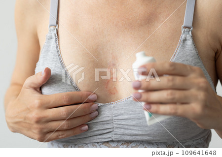 Woman in a bra for breastfeeding has allergy on her chest, holding cream for healing. Healing ointment. Closeup. 109641648