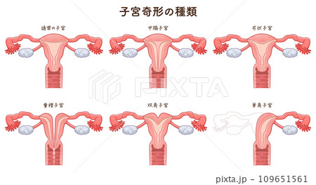 子宮奇形の種類・Uterine malformation 109651561