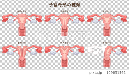 子宮畸形的類型/子宮畸形-插圖素材 [109651561] - PIXTA圖庫