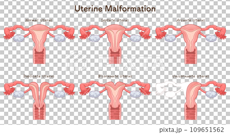 Uterine malformation 109651562